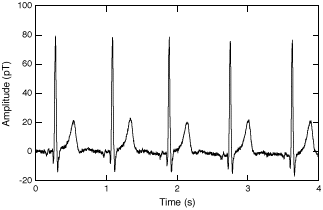 Real-time magnetocardiogram recorded with a multiloop magnetometer.